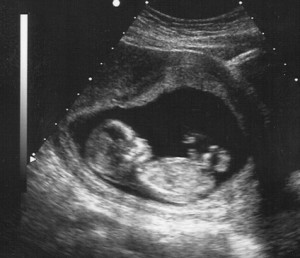 Robin E. Weiss - ultra sound - 13 weeks pregnant