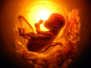 Josiane Keller - fetus Eileen with placenta