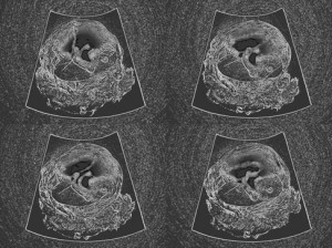 Josiane Keller - four Eileen ultrasound pictures