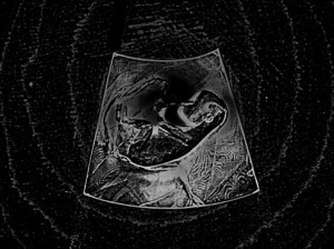 Josiane Keller - Eileen ultrasound test pic 2d only one layer gauze